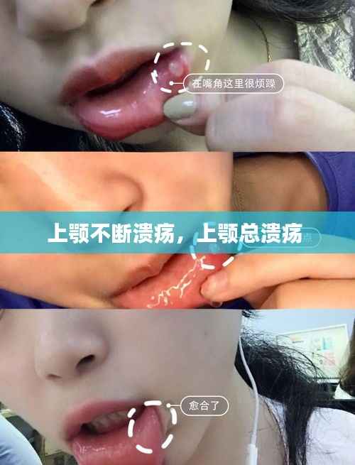 上顎不斷潰瘍，上顎總潰瘍 