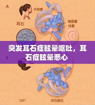 突發耳石癥眩暈嘔吐，耳石癥眩暈惡心 