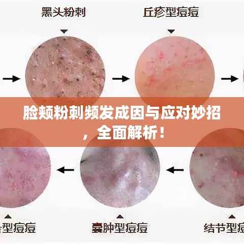 臉頰粉刺頻發成因與應對妙招，全面解析！